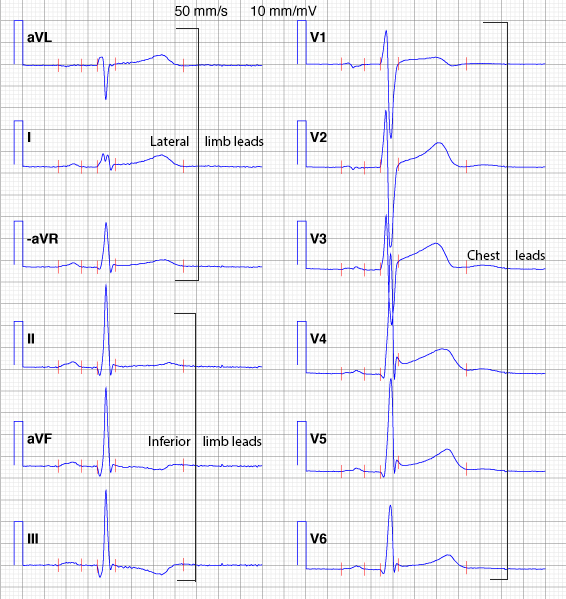 12 lead ecg leads limb chest cabrera format paper